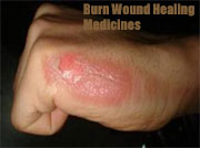 Burn Wound Healing